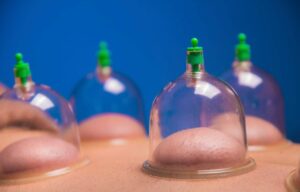 The Health Benefits of Hijama: A Comprehensive Guide to the Healing Power of Cupping Therapy